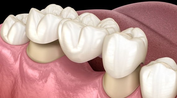 What Are Dental Bridges 1