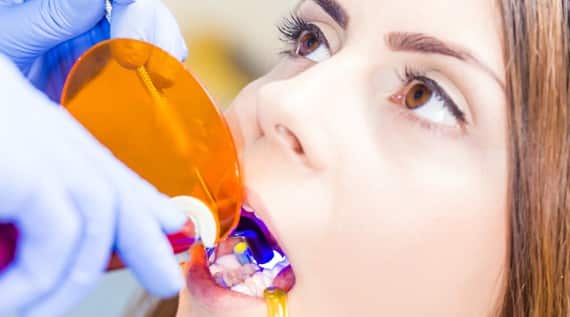 What Are Dental Bridges