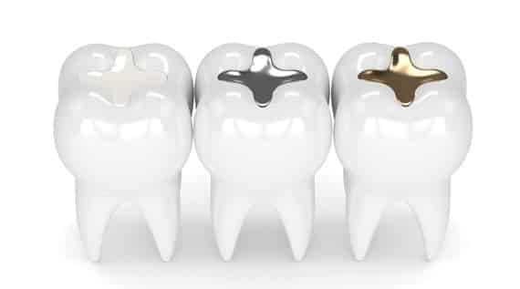 What Are Dental Fillings