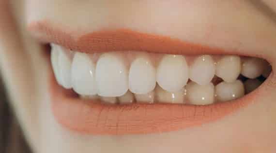 What Are Porcelain Veneers
