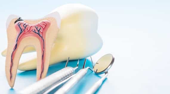 What Are Root Canals