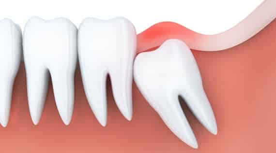 What Is Wisdom Teeth Removal