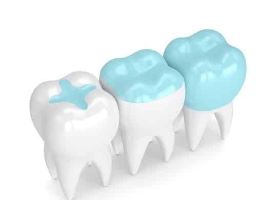 Procedure For Inlays And Onlays