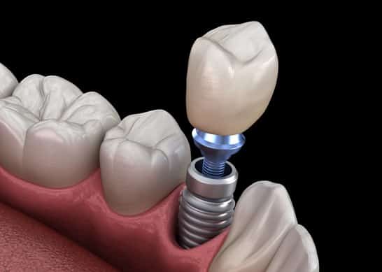 The Dental Implant Procedure