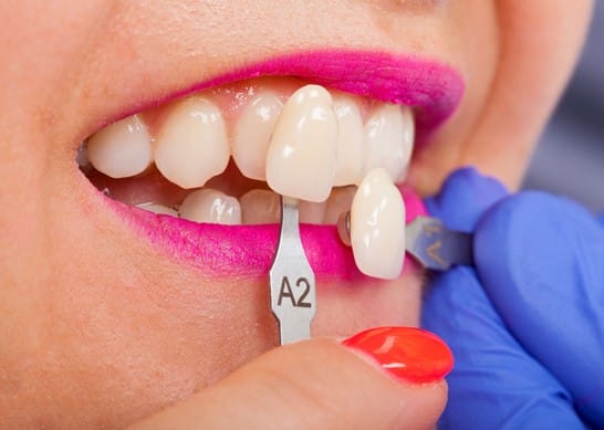 The Procedure For Porcelain Veneers