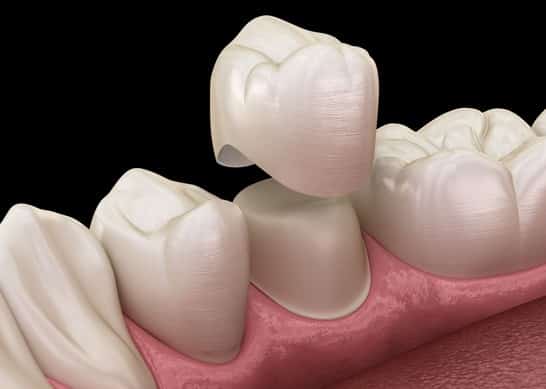 You Expect With The Dental Crown Procedure